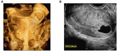 Expectant treatment for angular pregnancy after assisted reproduction technology: a safe and patient-friendly treatment strategy